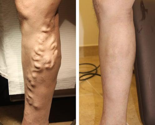 Outpatient Treatment of varicose veins with minimum invasive surgery