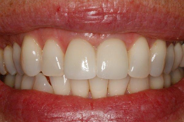 Hopeless tooth successfully replaced by a dental implant and crown