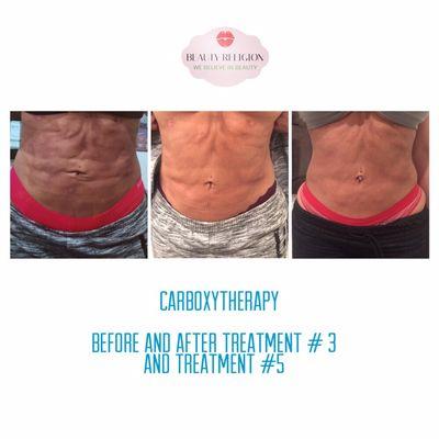 This Patient got uneven skin after liposuction. Five Carboxytherapy treatments were performed to smooth the dimples.