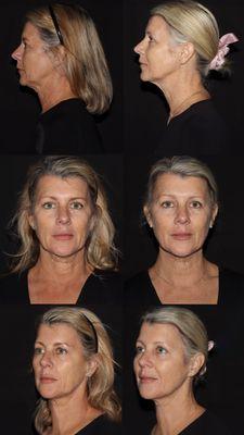 PRP therapy transformed the skin by reducing signs of aging and promoting a radiant, youthful appearance through natural healing and collage