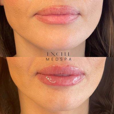 Before and after photos of our lip service treatment, showcasing the transformative results achieved by our skilled professionals.