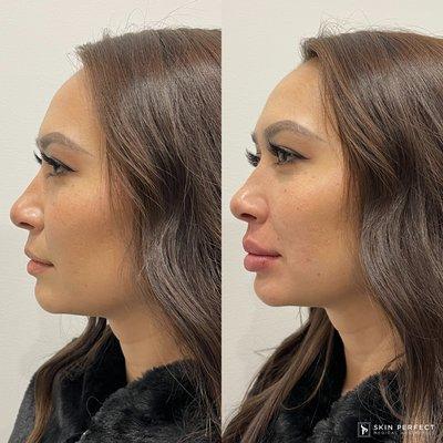 Lip Filler Before and After