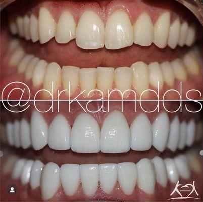 Everything from shade to shape is customized by design. Schedule a consultation with Dr. Kam about your smile makeover.