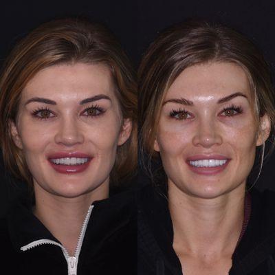 Redesigned her smile after veneers from another office didn't meet her expectations.