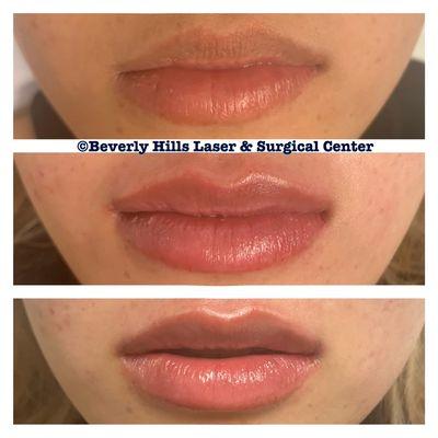 Beautiful lips by the best nurse injector Mary