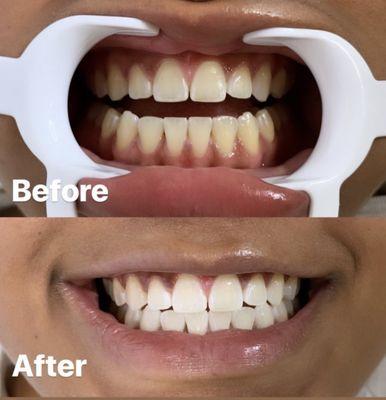 Teeth Whitening