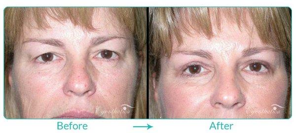 Blepharoplasty (Excess Skin) by Dr. Burnstine