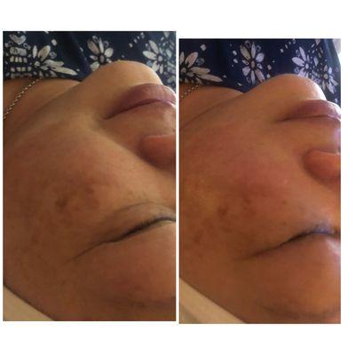 Healthy glowing skin reduced puffiness and helping client  with hyperpigmentation