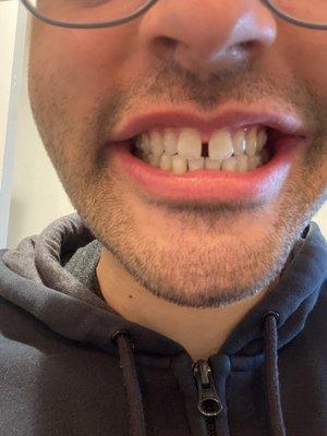 Week 1 of Invisalign