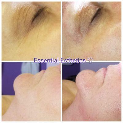 Before and after photos from one LED/microcurrent treatment provided by Cynthia at Essential Aesthetics.