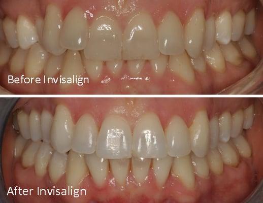 Crooked teeth restored with Invisalign.