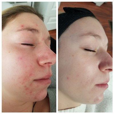 Acne facials. After only 4 acne facial treatments.