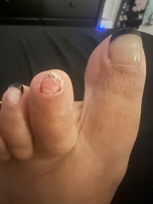 The entire toenail came off.