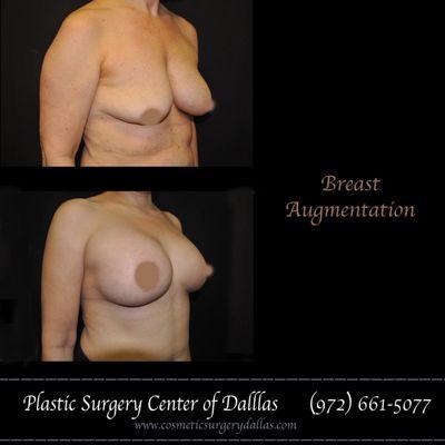 Breast Augmentation