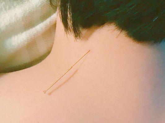 Acupuncture