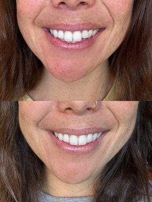 Before and after crown on lateral incisor