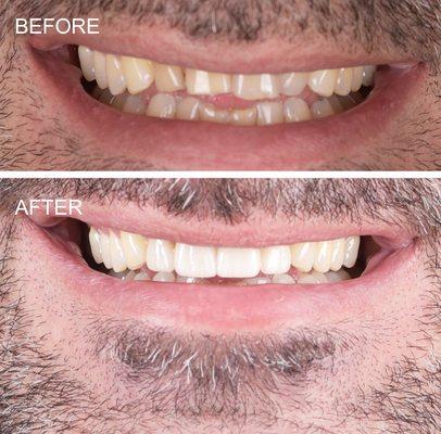 Worn teeth reconstructed with porcelain crowns.