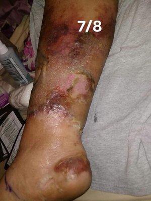 Infection from another spa. Please make sure your spa uses sanitary practices