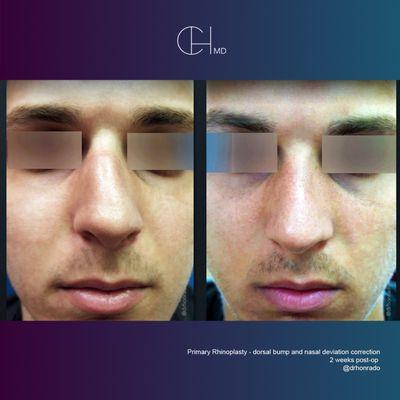 Carlo Honrado, M.D., F.A.C.S.- Primary Rhinoplasty & Septoplasty (dorsal bump and nasal deviation correction) patient 2 weeks post-op