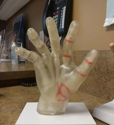 Model of a hand with joint inflammation