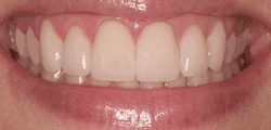 Before & After Veneers