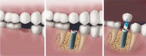 Dental Implants to Replace Missing or Broken Teeth