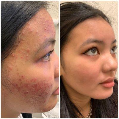 Acne treatment before and after