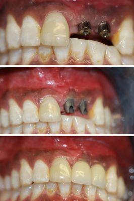 Two front tooth implants on a Boxer!