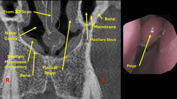 Combined photo of 3D scan and polyp.