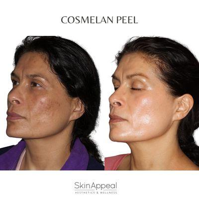 Cosmelan Peel