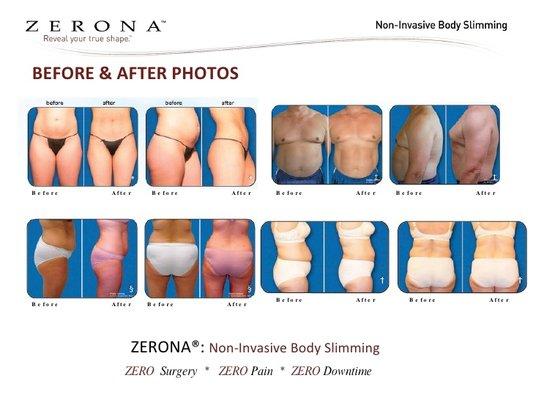 No Pain, Downtime, or side effects. Try our "One Visit Zerona Z6 Challenge". If you don't lose 1/4 inch from the waist you pay nothing!