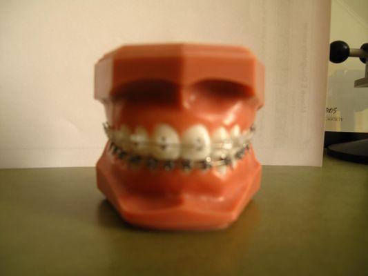 Offer Clear Braces