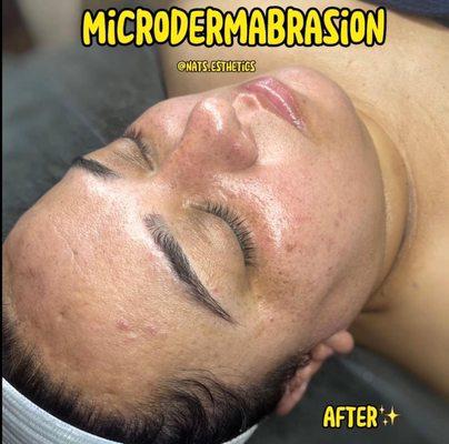 Microdermabrasion treatment after!