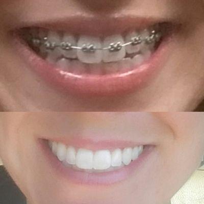 8 months of ortho, using elastics nightly to close open bite