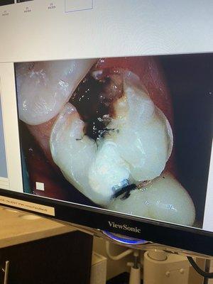 The black is all the infection they left in my tooth, the white filling right next to it is were they did my "root canal" .