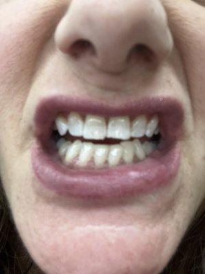 A line across my teeth of partial white and partial discoloration. The discoloration is my normal tooth color.