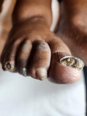 Fungus and thick toe nails