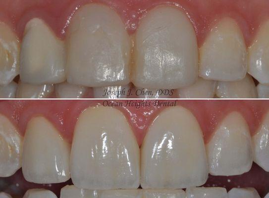 The difference between composite "bondings" and lab fabricated all-ceramic crowns and/or veneers