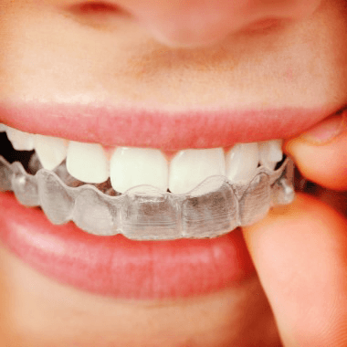 invisalign