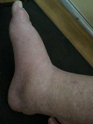 My brothers swollen feet