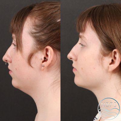 Submental Liposuction with Fat Grafting to Chin and Cheeks