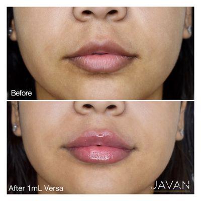 Dermal fillers for lips!