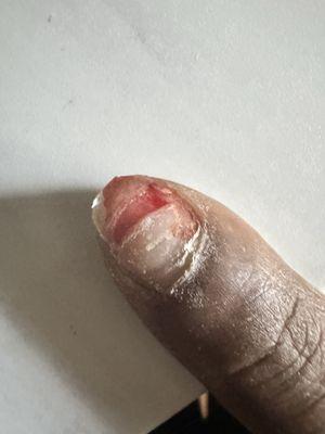 My nail was destroyed