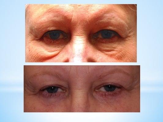 Lower Eyelid Blepharoplasty