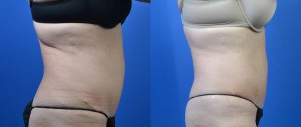 25 Minute Laser Treatment that melts the fat