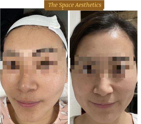 Chemical peel for melasma and sun spots