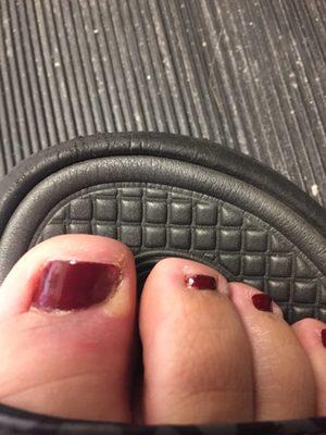 Toe nail infection!!!