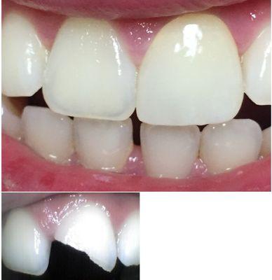 Young patient, broke his front tooth while playing football, it was restored with CERAMIC crown.