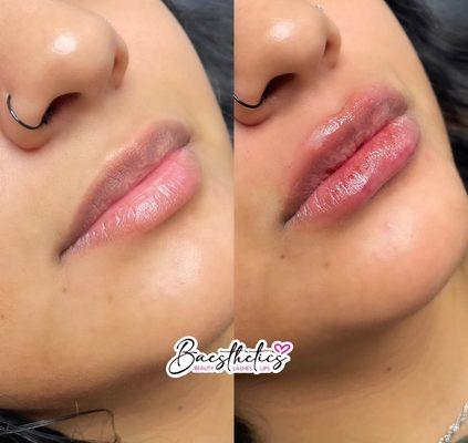 Needless Lip Filler - Pre1mL