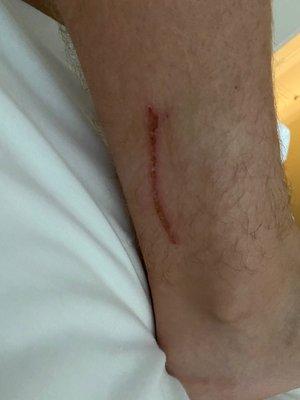 Sliced leg from sharp metal on pontoon boat